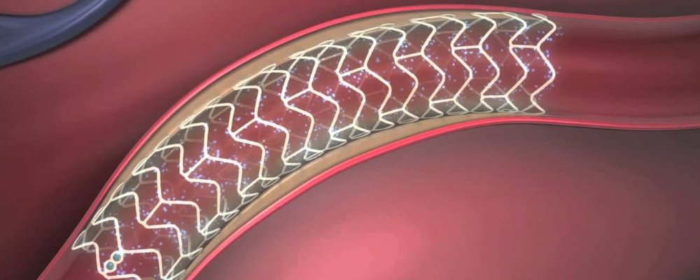 stent